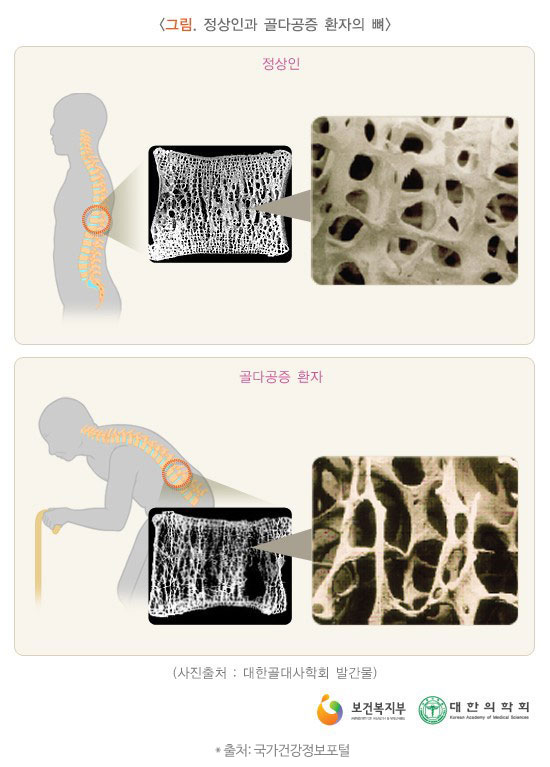 골다공증