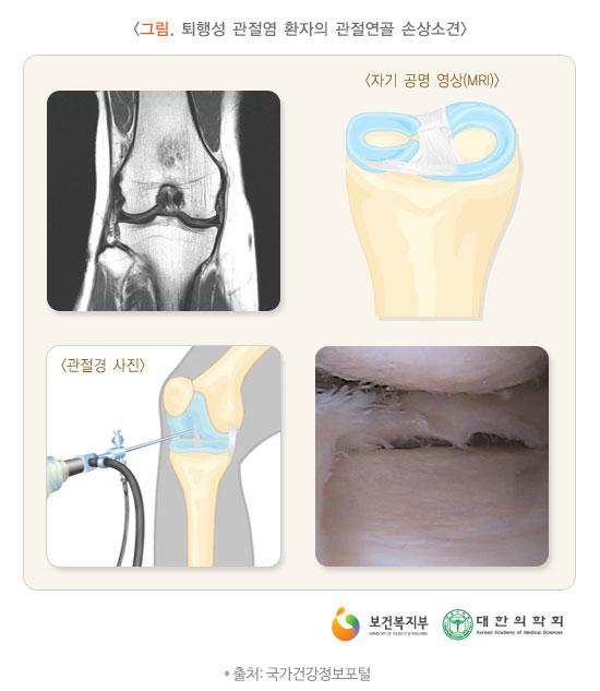 퇴행성 관절염 증상
