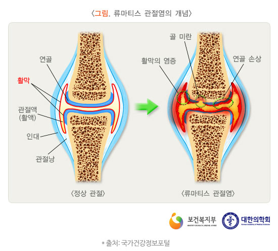 퇴행성 관절염