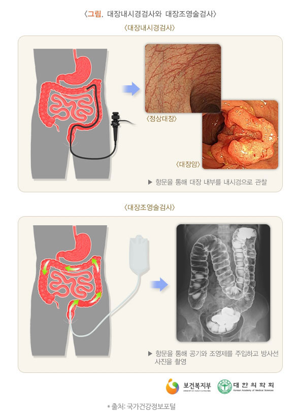 대장내시경검사와 대장조영술 검사